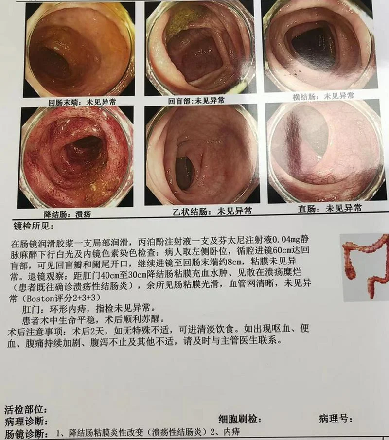 什么是慢性肠炎症状_1