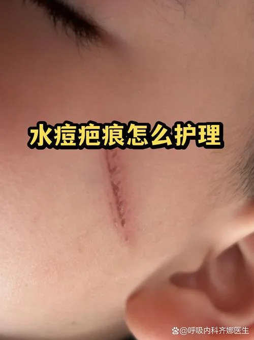 疱疹好了留疤了怎么办_2