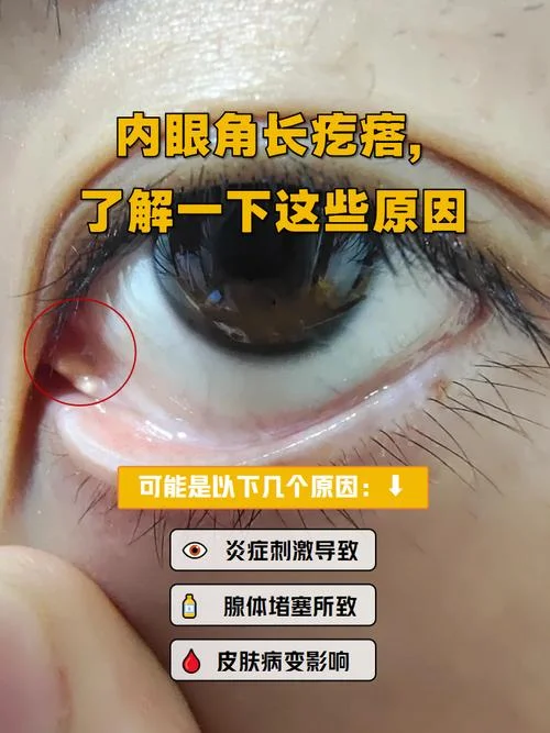 内眼角里面的肉叫什么_1