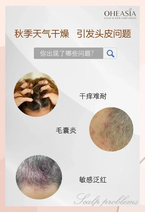头皮有蜡怎么办-头皮有蜡怎么办