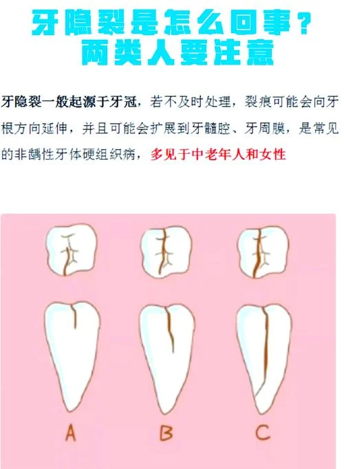 什么是纵裂-什么是纵裂