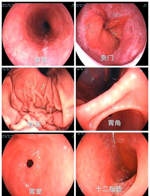 什么是消化性溃疡_1