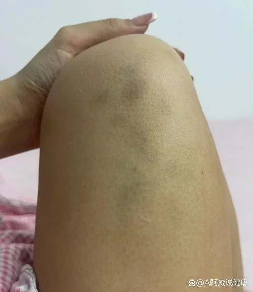 梦见腿被别人砍了-梦被斩腿