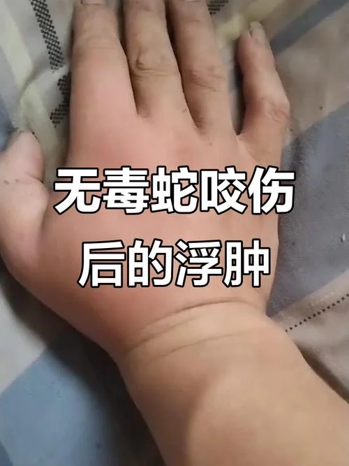 梦见被蛇咬住手不松口-蛇咬手不松