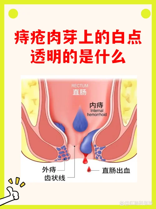 痔疮具体是个什么东西_1