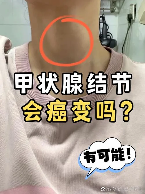 什么是甲状腺单发结节_1