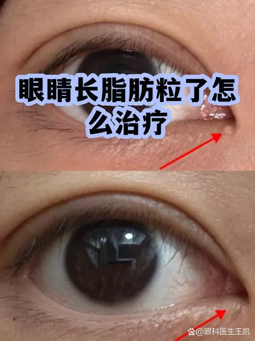 脂肪粒挑出处理_1