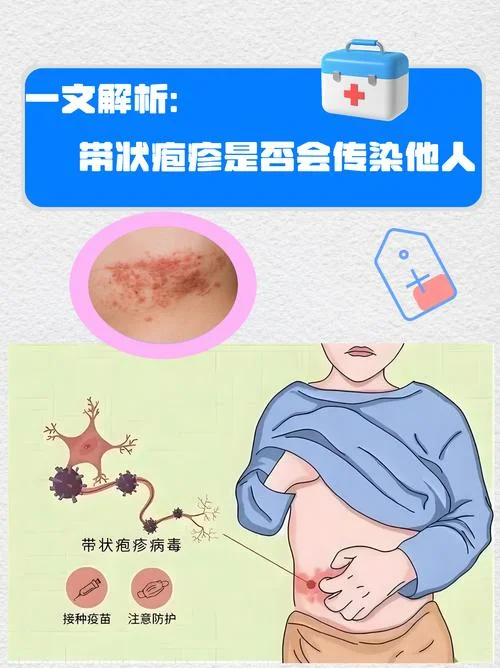缠腰龙怎么办-缠腰龙如何应对