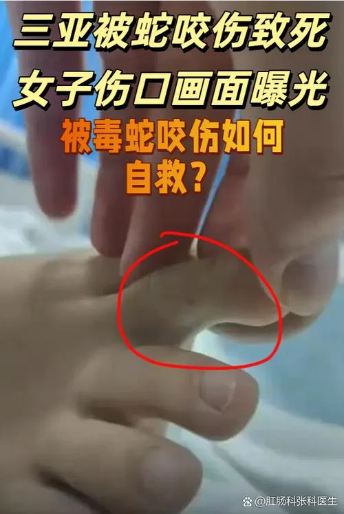 女人梦到蛇咬自己-梦见蛇咬女人