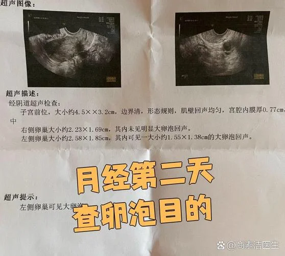 如何查卵巢是否正常_2