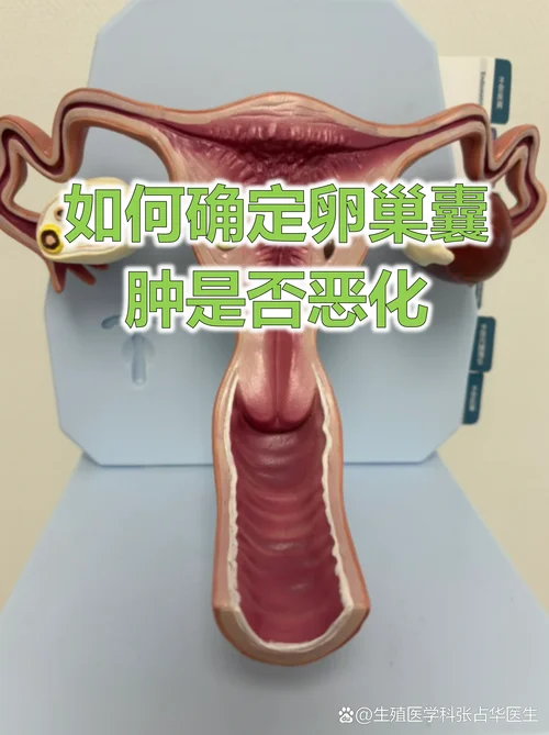卵巢囊肿七公分怎么办-囊肿七公分需就医