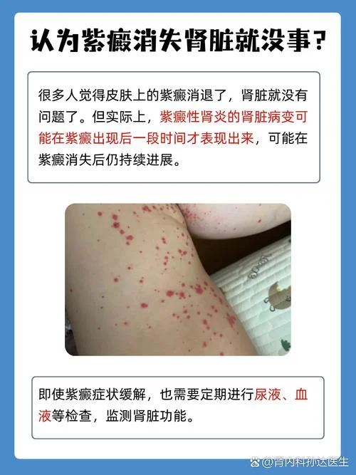 青少年肾炎如何查-青少年肾炎筛查