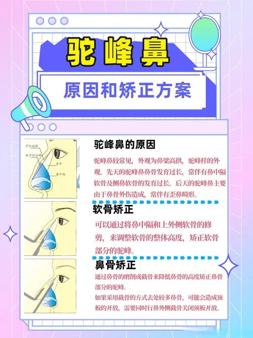 什么是驼峰鼻_1