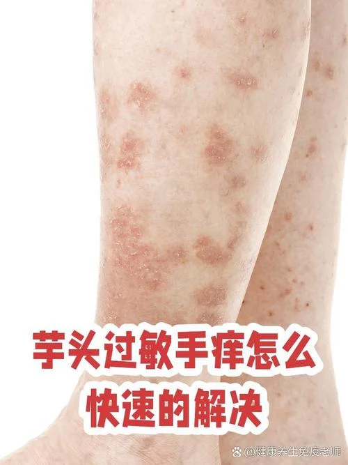 毛芋手痒怎么办-毛芋手痒怎么办