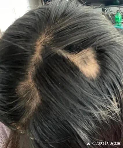 梦见头发掉了秃了3块-