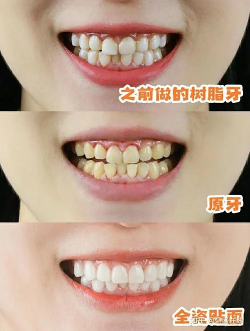 牙齿瓷贴面要多少钱-价格咨询 10 字内