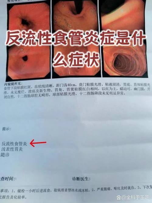 什么是三级胃病_1