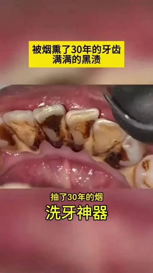 梦见牙齿有牙垢-梦牙垢