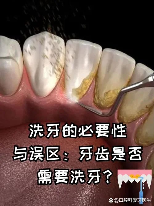 洗牙结石的原理_2