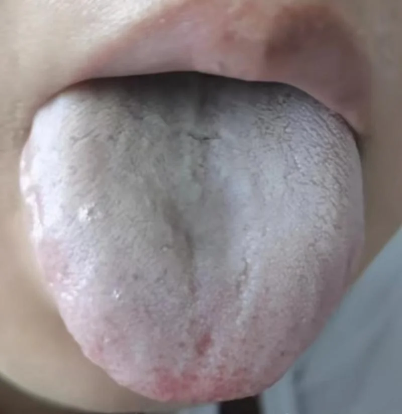 梦见舌苔多_1