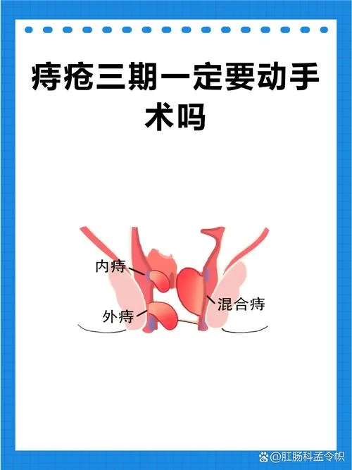 痔核脱出自己割_1