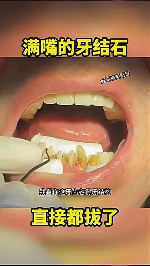 梦见牙结石掉了好多-梦落满口牙石