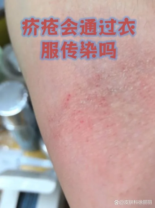 疥疮是种什么病_1