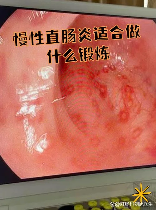 肠炎如何查_1