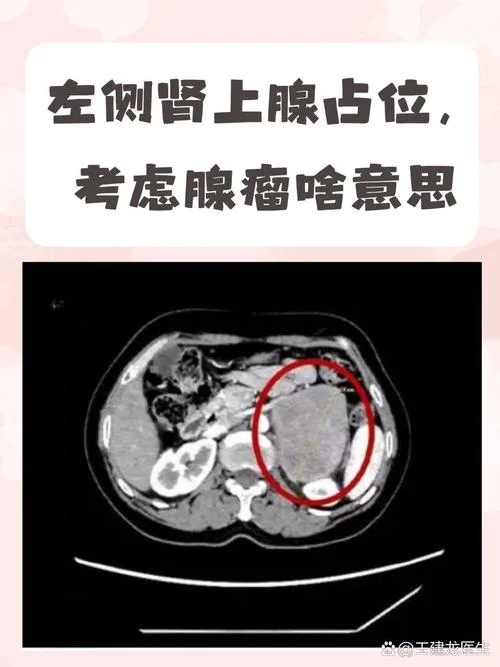 什么是左肾癌_2