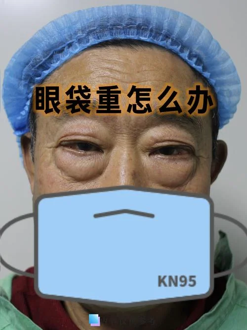 眼袋该怎么办_1