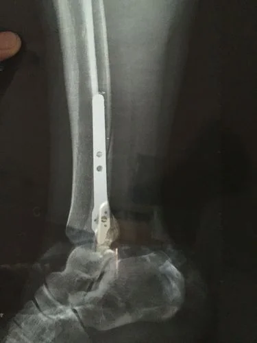 梦见腿断了但是还能走-断腿仍能行走
