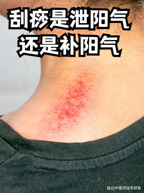 痧道理疗疗卢姐_1