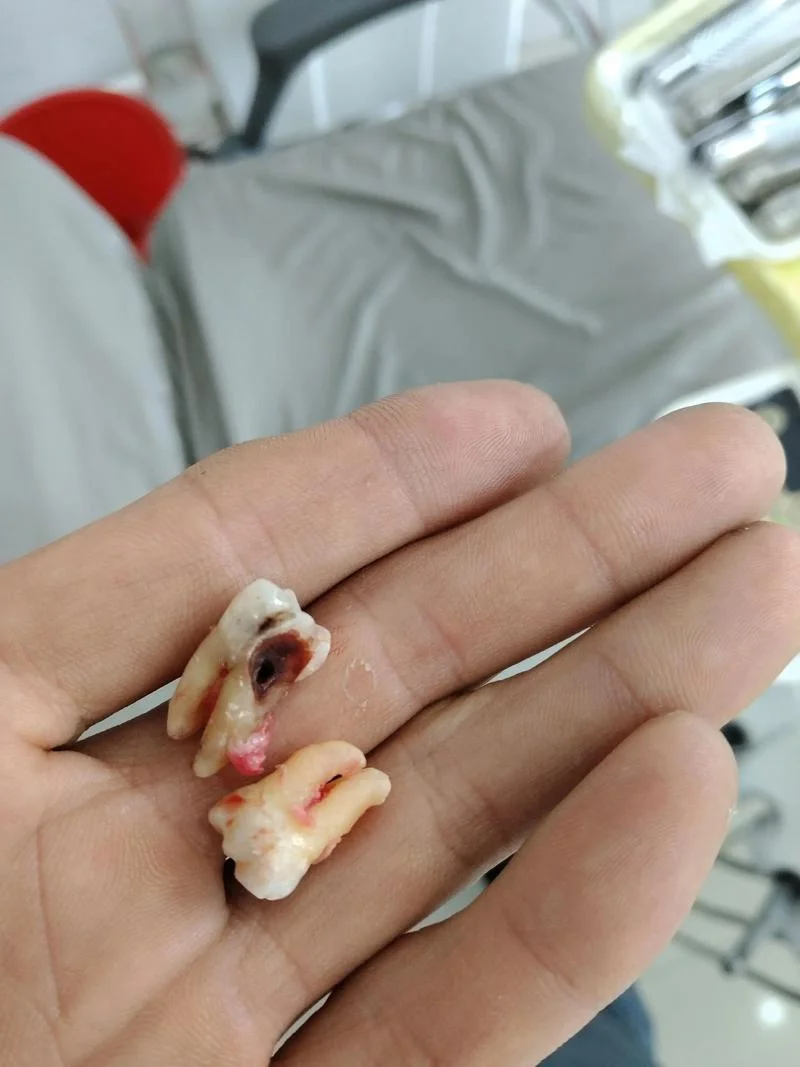梦见牙齿掉了两颗血_2