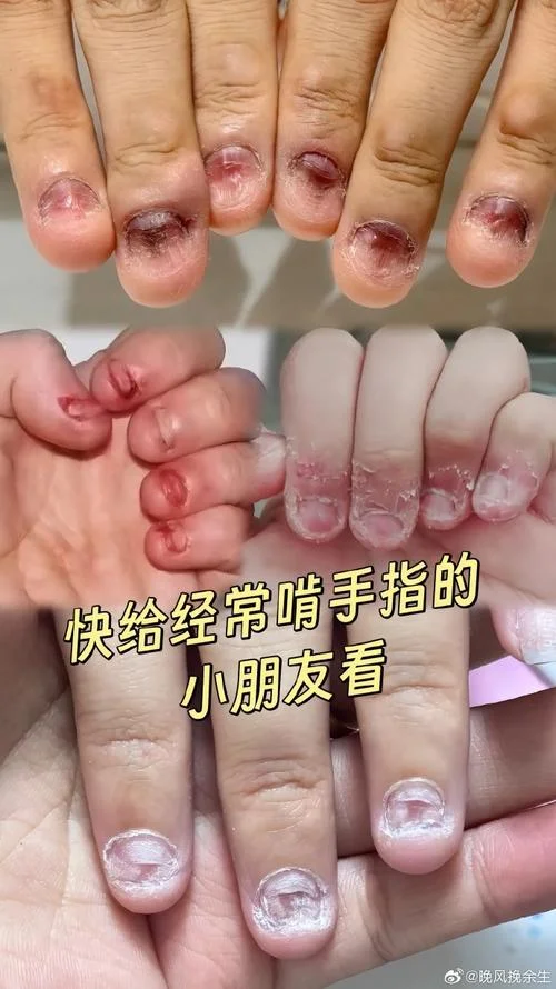 梦见小狗咬我手指甲-梦中小狗咬我指甲