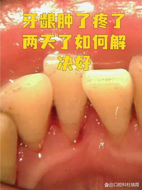 做梦梦到牙龈肿了_2