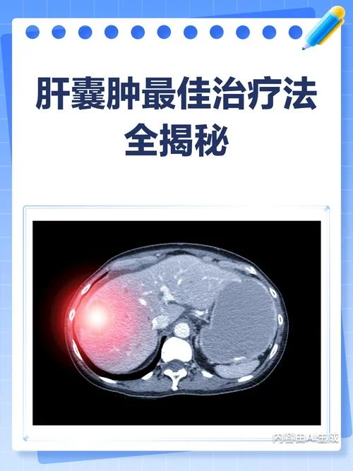 肝囊肿寄生虫如何查-查肝囊肿寄生虫