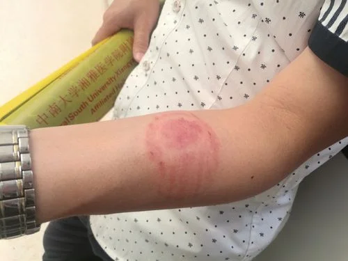 金子被咬出牙印怎么办_2