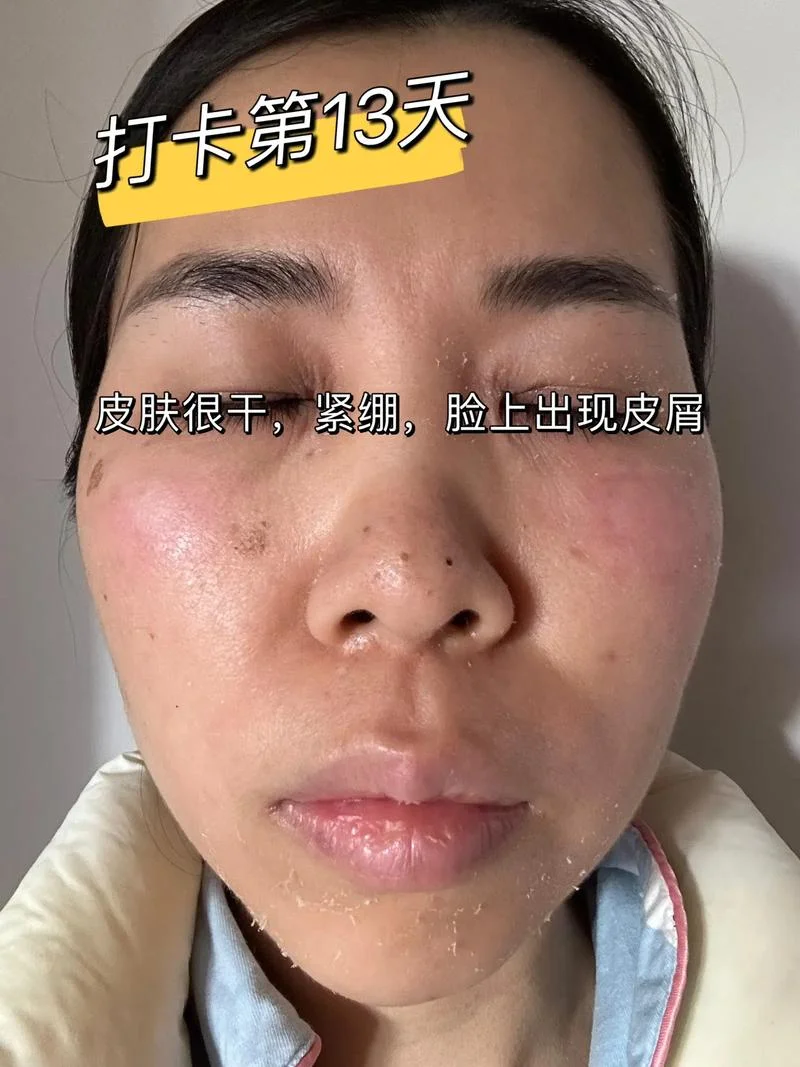 用祛斑霜脸上脱皮怎么回事-祛斑霜脱皮原因