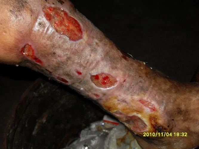 梦见自己摔倒了腿烂了_1