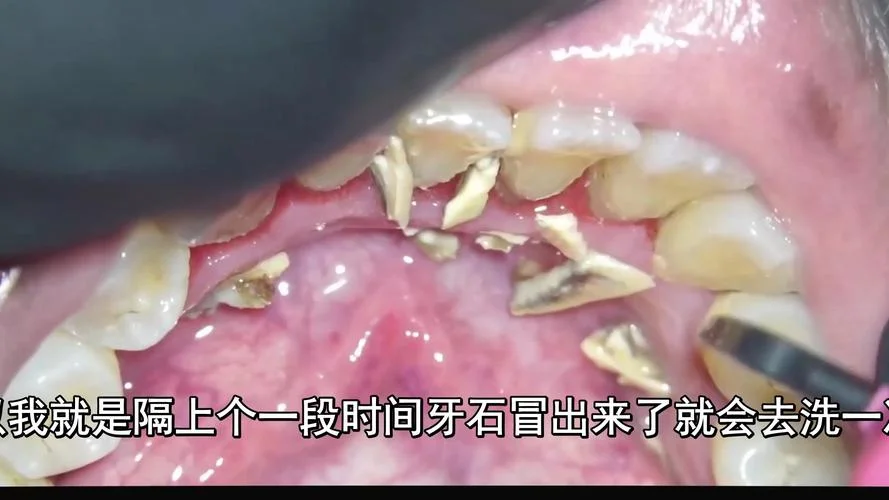 梦见自己抠牙结石掉落-抠牙结石梦成真