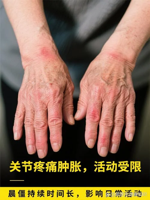 什么是风湿性关节病_2
