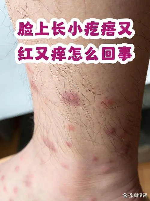 做梦梦到脸过敏了都是疙瘩-脸过敏疙瘩梦