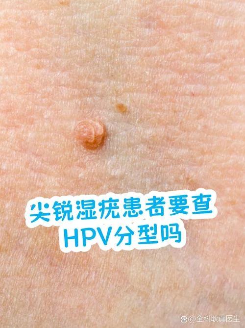 盘锦在哪查hpv-盘锦查询 HPV（10 字）