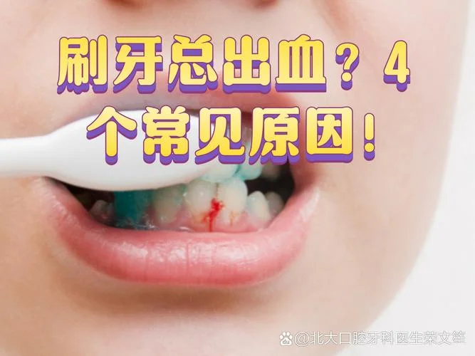 刷牙老是出血是为什么_2