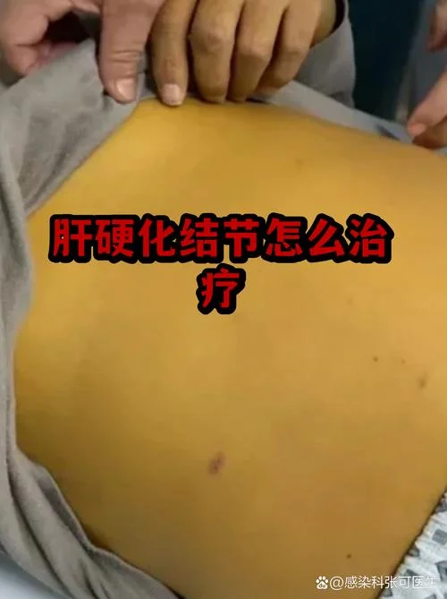 如何查肝结节性质_1