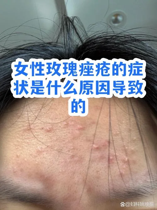 脸颊上长痘痘是为什么_1