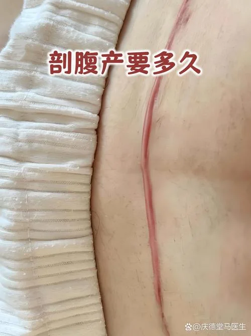 剖腹产历史追溯_2