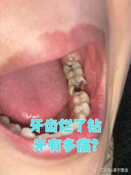 梦见烂牙齿-梦见烂牙齿