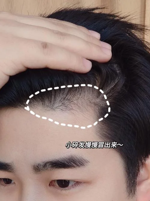 什么是发际线啊_1