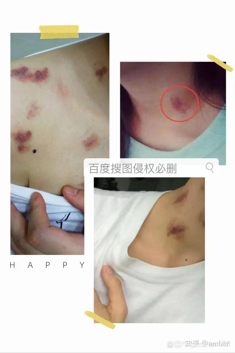 梦见吻痕_2